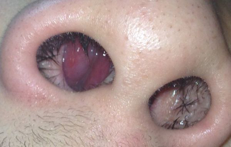 嚴重紅腫藥物性慢性鼻炎