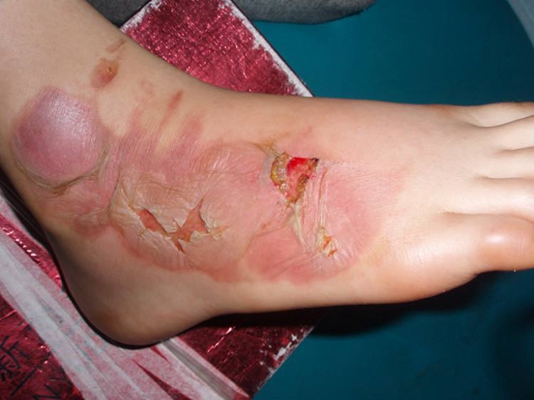 深二度燒傷 (50) 