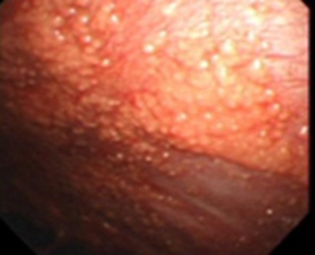 結核性胸膜炎早期的症狀的