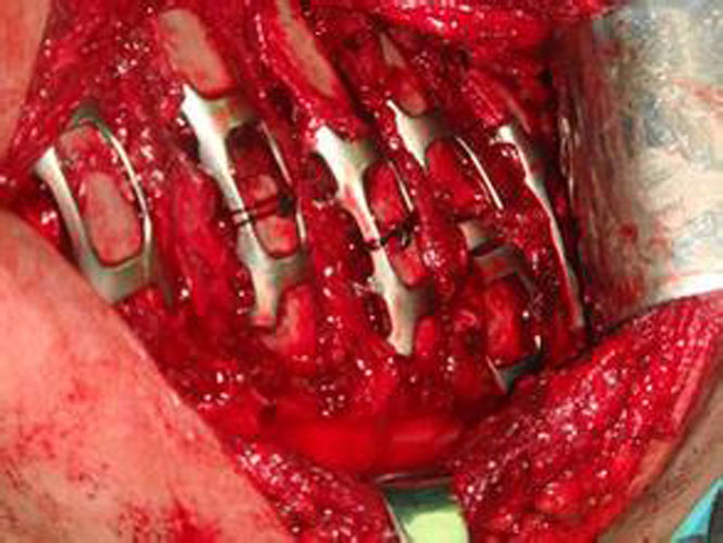 特別嚴重的肋骨骨折