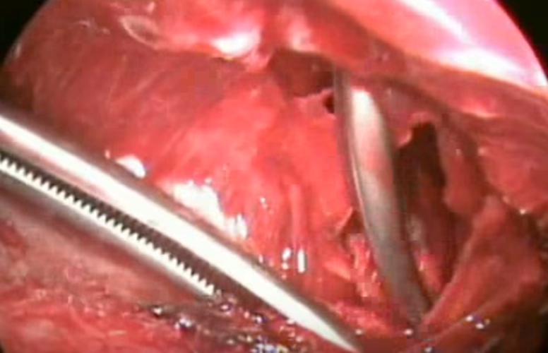 結核性胸膜炎做穿刺的