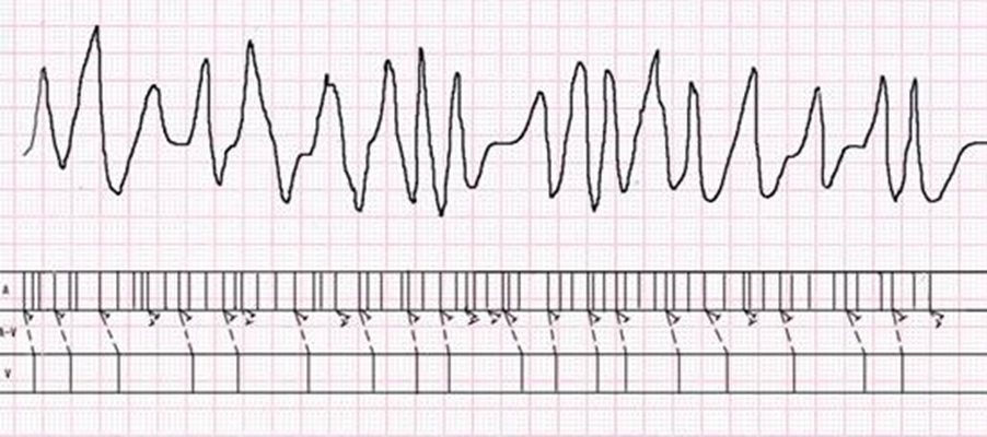 預激綜合徵心電圖 (80) 