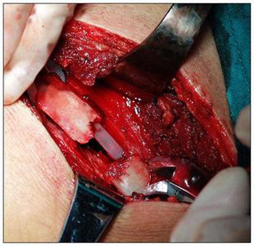 清晰的肋骨骨折