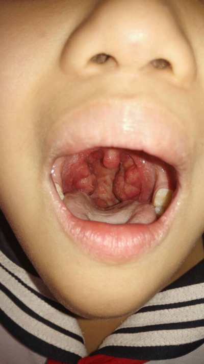 食道炎的症狀圖 (50) 