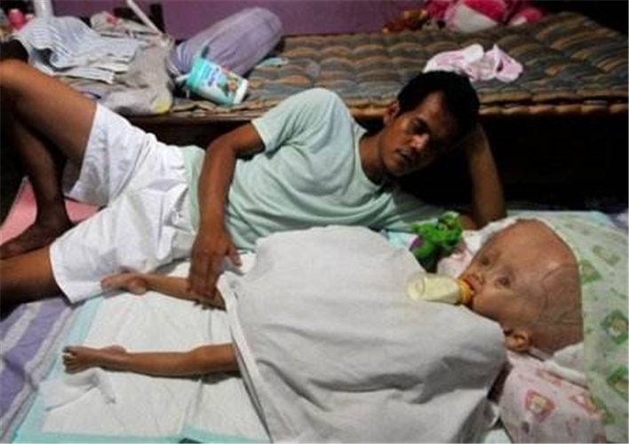 重度腦積水日常護理