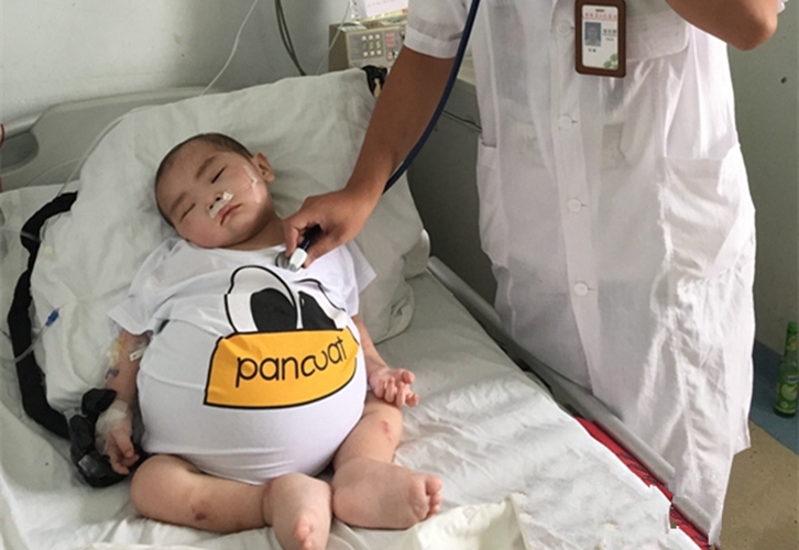 糖尿病腎病全身水腫