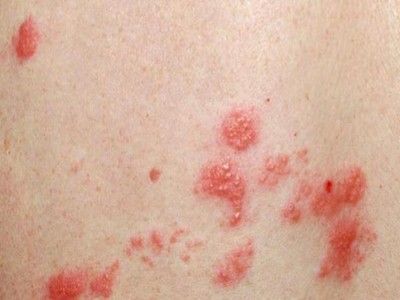 性病性淋巴肉芽腫套圖 (5) 