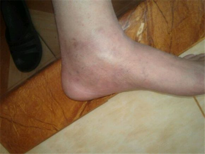 足部淺表型靜脈炎