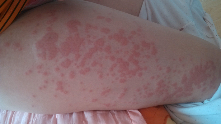 嬰兒蕁麻疹 (47) 