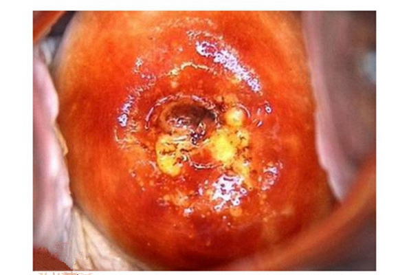 淋病的症狀 (48) 