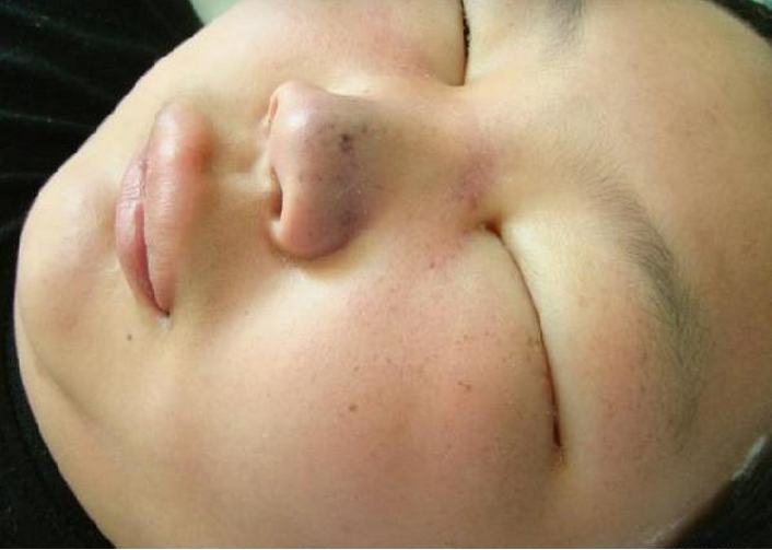 植物日光性皮炎