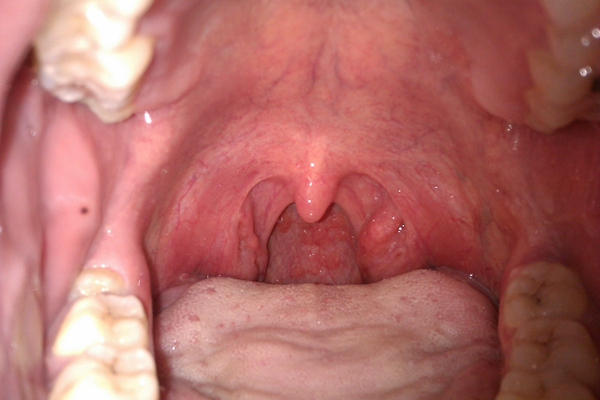 食道炎症狀 (35) 