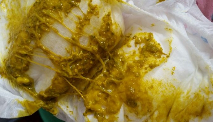 新生兒消化不良大便圖 (49) 
