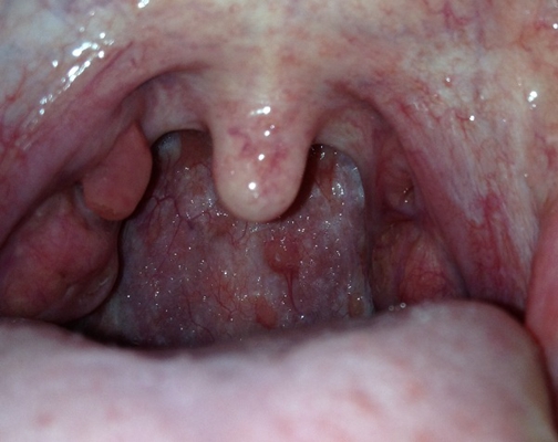 食道炎的症狀圖 (7) 