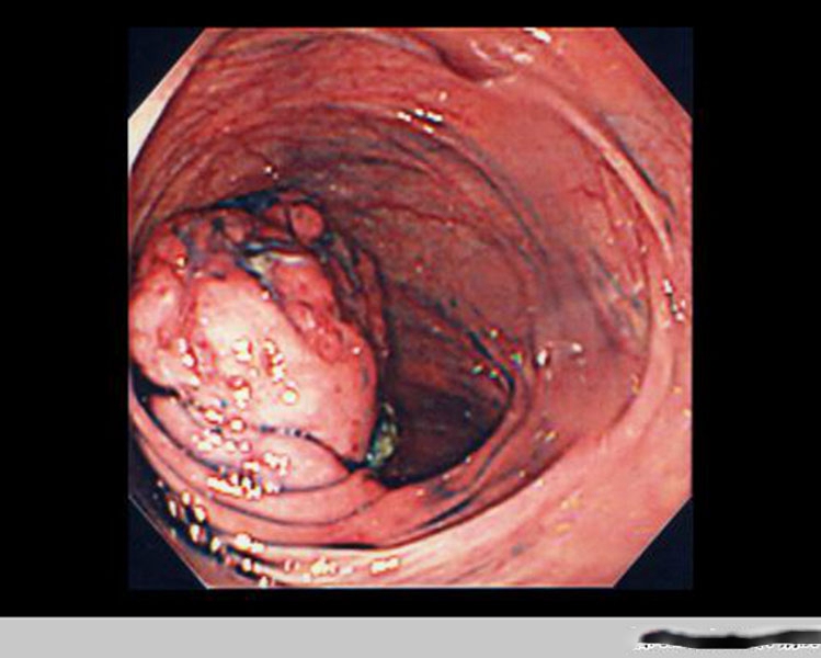 直腸腸腫瘤真實