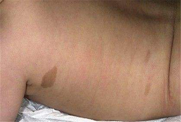 牛奶咖啡斑 (48) 