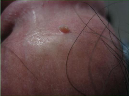 男性尖銳溼疣照片 (38) 