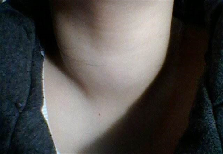 女性甲狀腺結節頸部