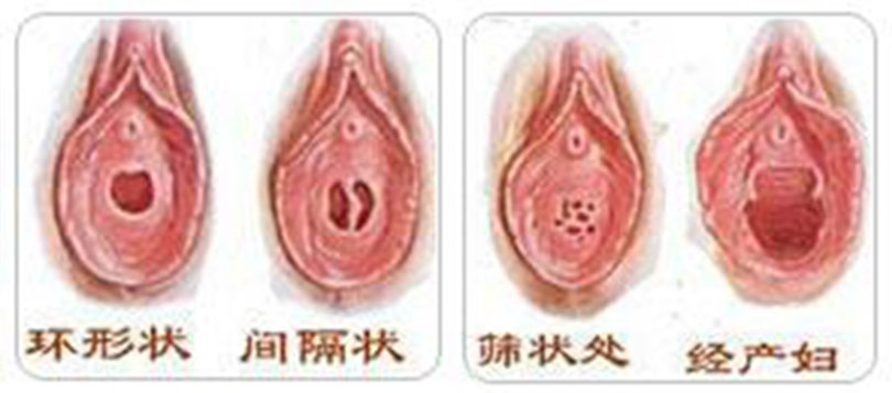 一邊外陰唇肥大