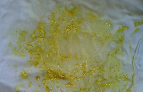 新生兒消化不良大便圖 (52) 