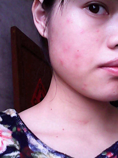 急性皮炎的症狀