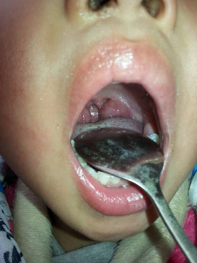 食道炎的症狀圖 (48) 