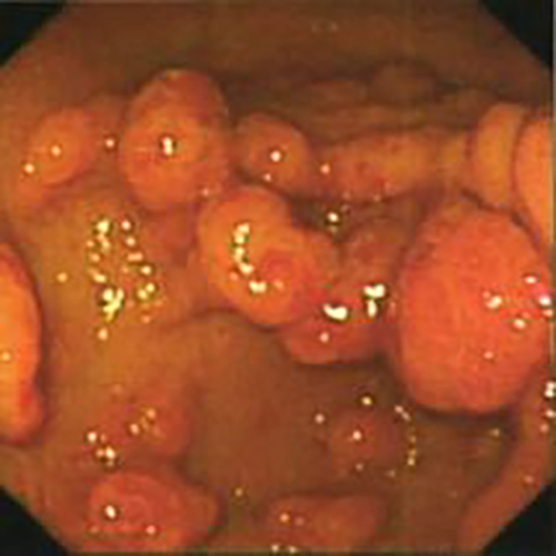 增生性胃息肉症狀