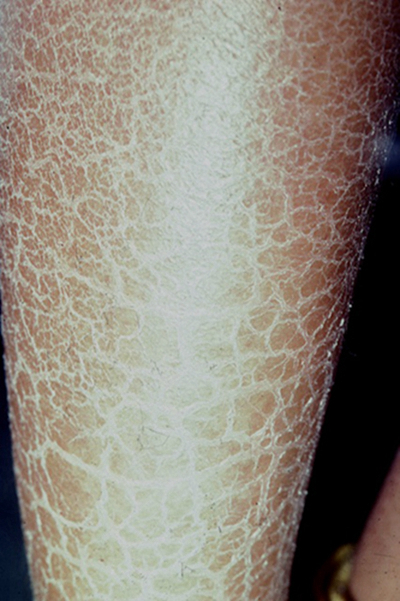 小腿皮膚像魚鱗 (48) 