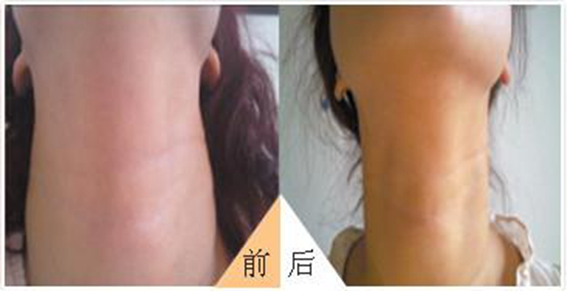 橋本甲狀腺炎腫大治療前後