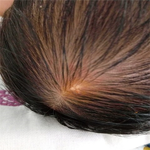 皮脂腺痣新生兒頭部