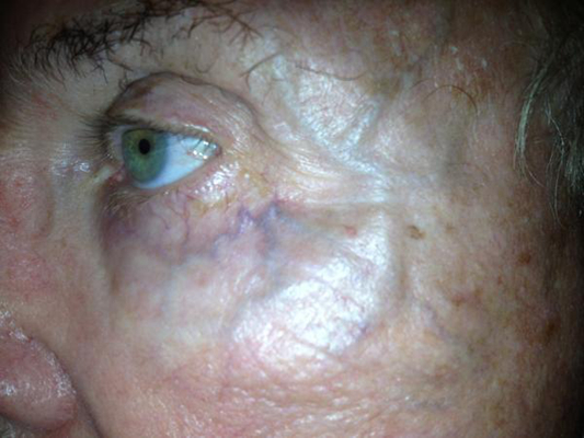 頸靜脈怒張 (46) 