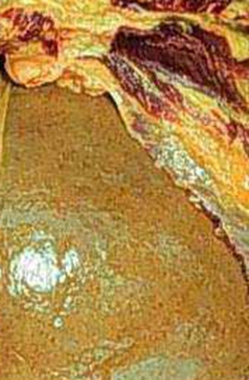  重度的酒精肝併發症