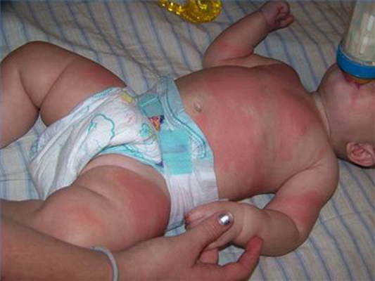 嬰兒蕁麻疹 (50) 