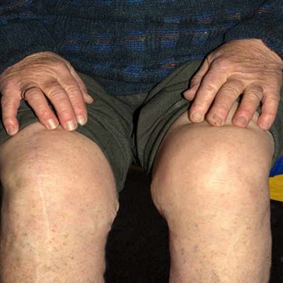 膝蓋骨質增生 (37) 