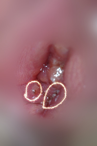 黴菌陰炎症狀 (4) 