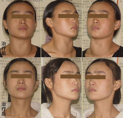 頜下淋巴結腫大