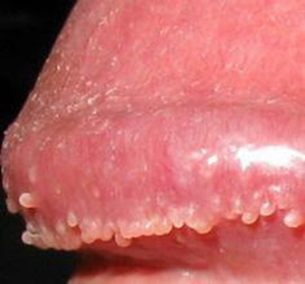 性病性淋巴肉芽腫套圖 (44) 