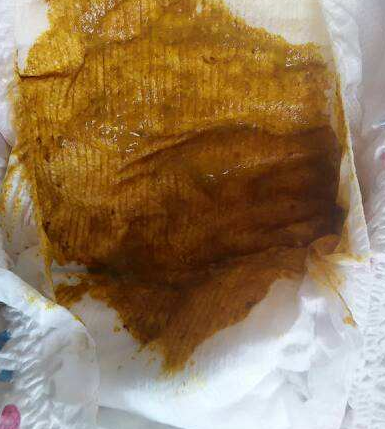 新生兒消化不良大便圖 (7) 