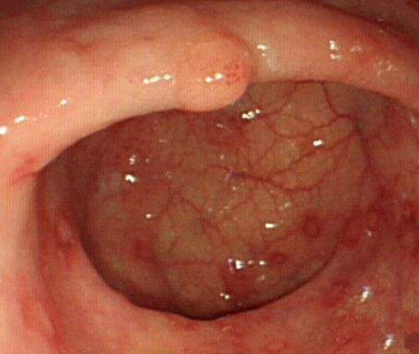 中年慢性結腸炎患者的