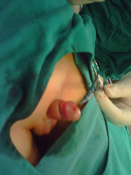 嚴重尿路感染的症狀