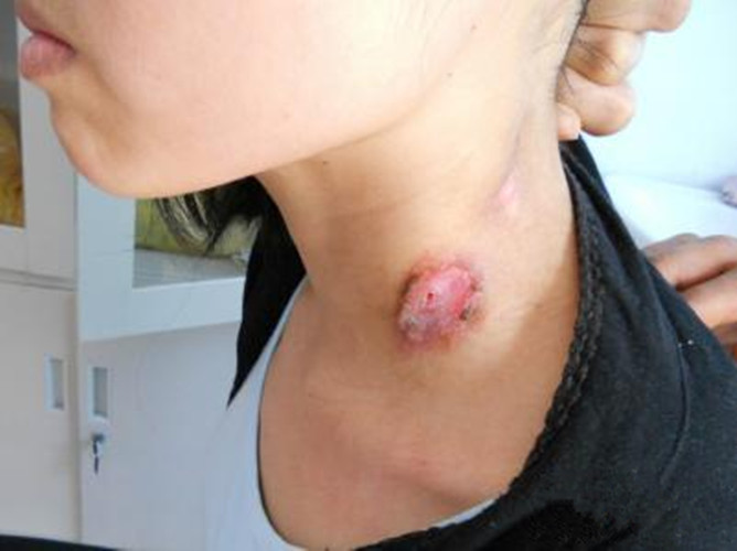 頜下的淋巴結核青年