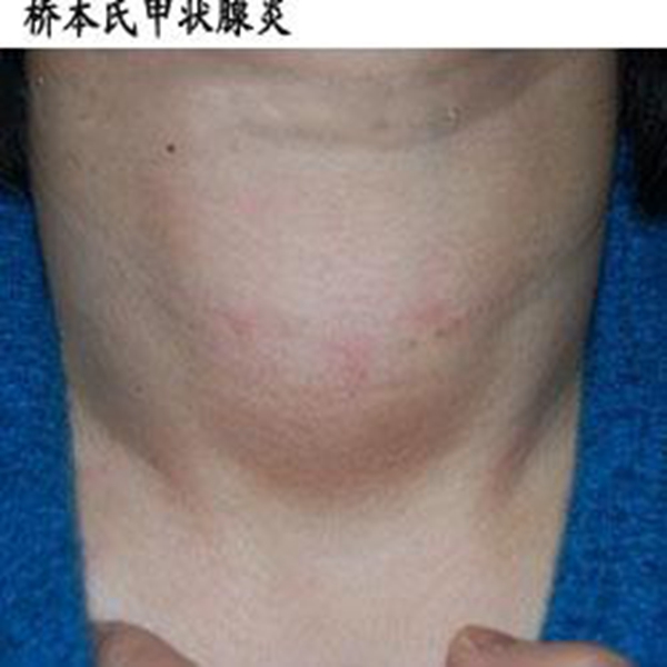 橋本甲狀腺炎腫大嚴重