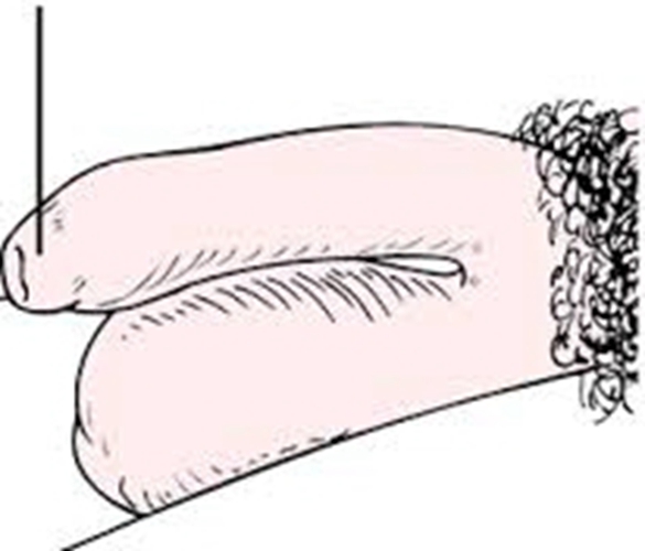 早期陰莖癌症狀