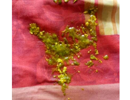 新生兒腹瀉大便