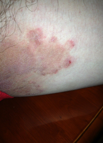 體股癬初期現象