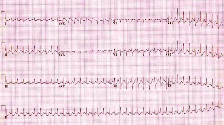 預激綜合徵心電圖 (83) 