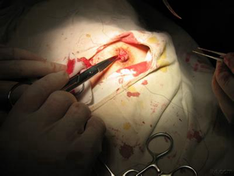 孕婦乳頭內陷有圖 