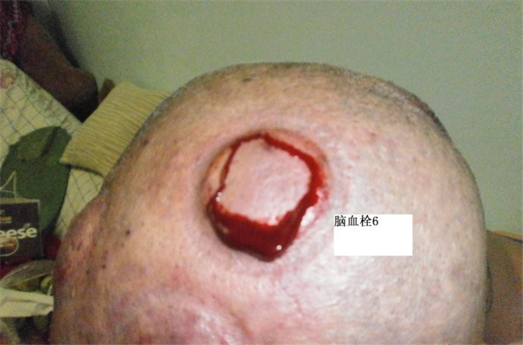 腦血栓中醫治療