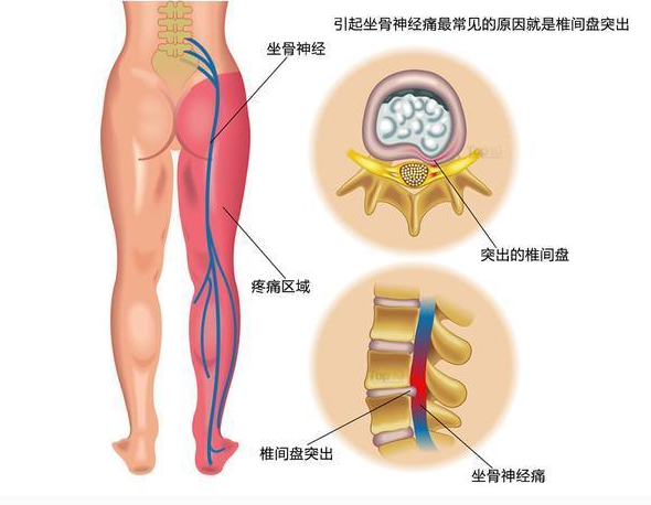 坐骨神經痛的症狀圖 (47) 