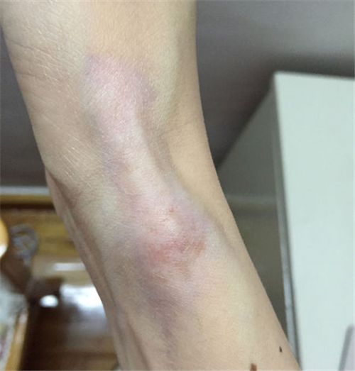 嚴重的手腕腱鞘炎